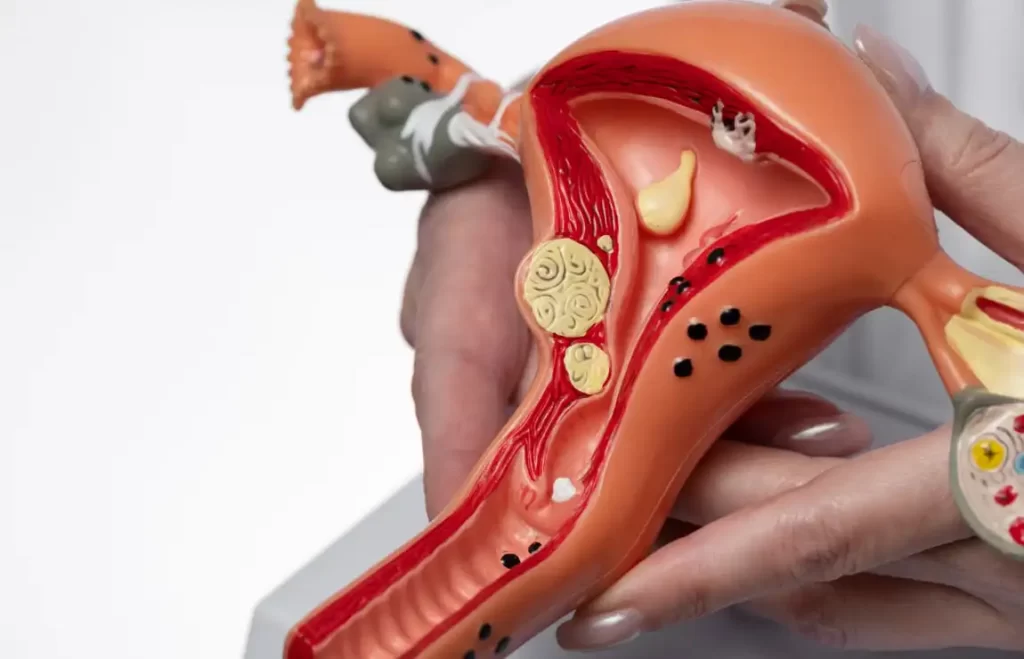 Endometriose: o que é?