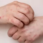 MPOX o que é?