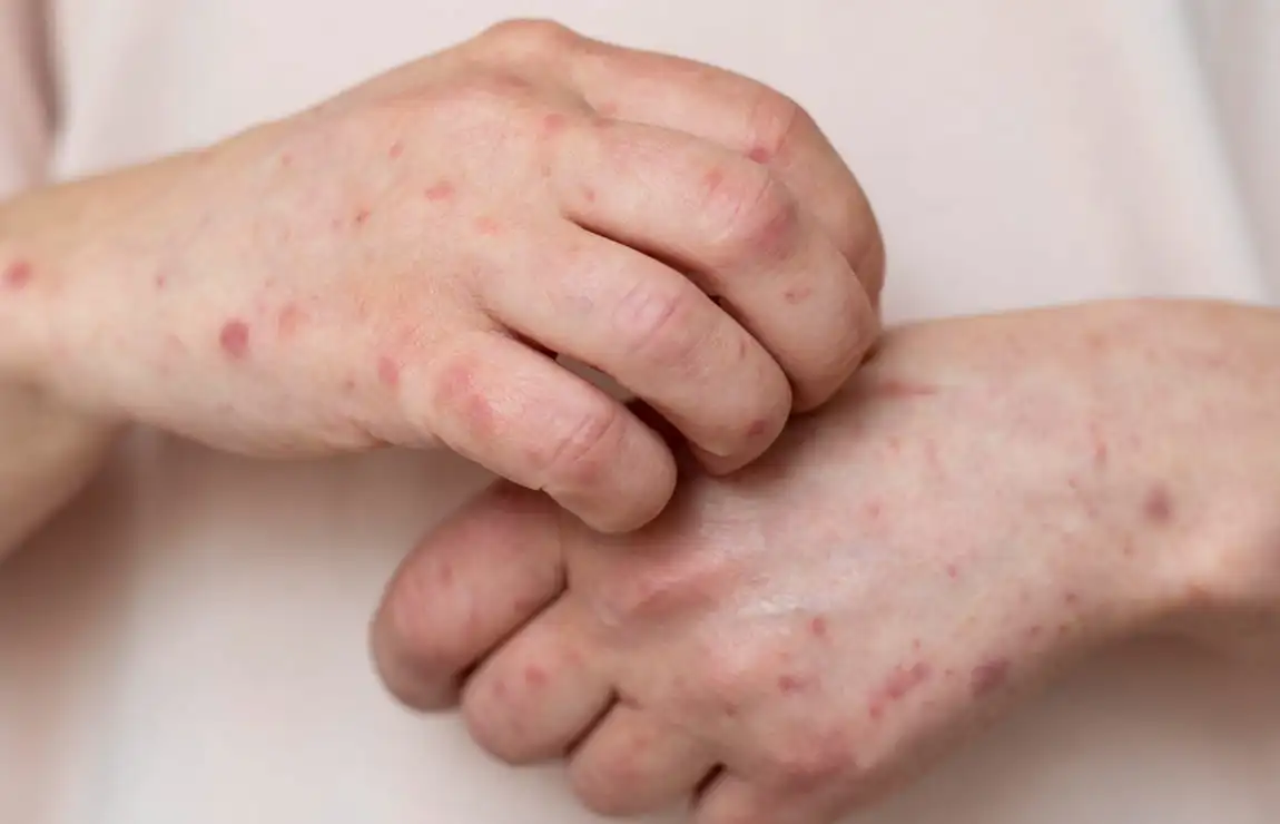 MPOX o que é?